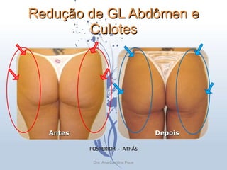 Redução de GL Abdômen e Culotes POSTERIOR  -  ATRÁS Antes Depois Dra. Ana Carolina Puga 