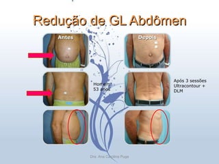 Redução de GL Abdômen Após 3 sessões Ultracontour + DLM Homem 53 anos Depois Antes Dra. Ana Carolina Puga 