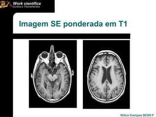 Imagem SE ponderada em T1 
