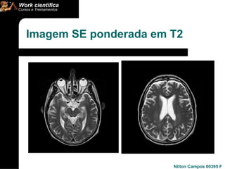 Imagem SE ponderada em T2 