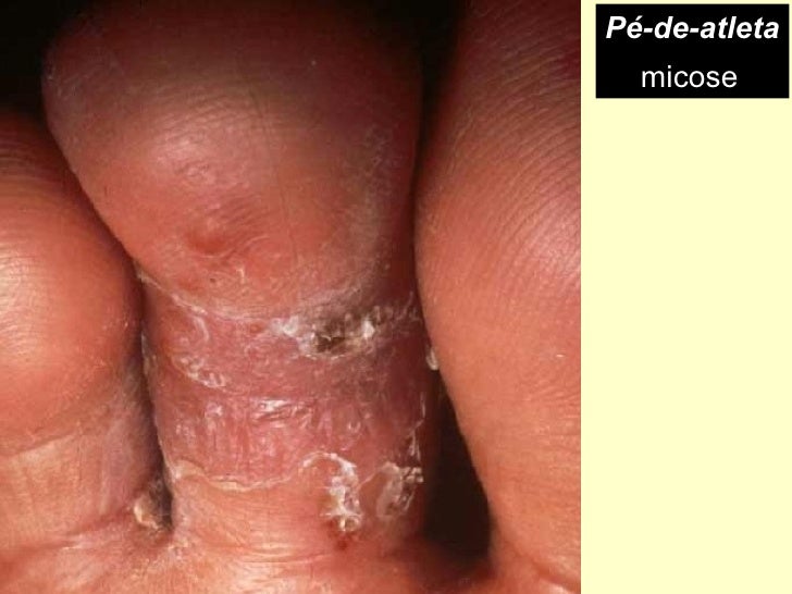 Medicina forte de um fungo de pé