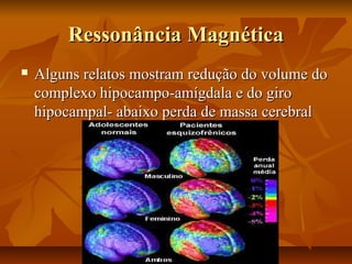 Ressonância MagnéticaRessonância Magnética
 Alguns relatos mostram redução do volume doAlguns relatos mostram redução do volume do
complexo hipocampo-amígdala e do girocomplexo hipocampo-amígdala e do giro
hipocampal- abaixo perda de massa cerebralhipocampal- abaixo perda de massa cerebral
 