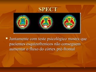 SPECTSPECT
 Juntamente com teste psicológico mostra queJuntamente com teste psicológico mostra que
pacientes esquizofrenicos não conseguempacientes esquizofrenicos não conseguem
aumentar o fluxo do córtex pré-frontalaumentar o fluxo do córtex pré-frontal
 