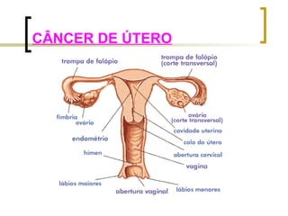 CÂNCER DE ÚTERO 
 