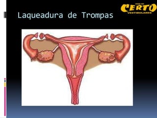 Laqueadura de Trompas
 