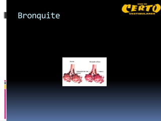 Bronquite
 
