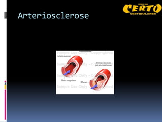 Arteriosclerose
 