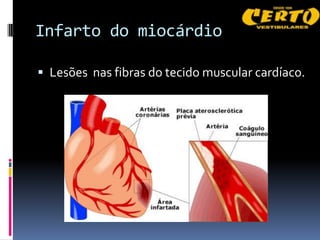 Infarto do miocárdio

 Lesões nas fibras do tecido muscular cardíaco.
 