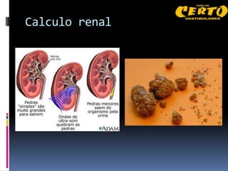 Calculo renal
 