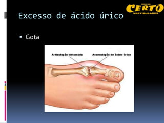 Excesso de ácido úrico

 Gota
 