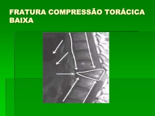 FRATURA COMPRESSÃO TORÁCICA
BAIXA
 