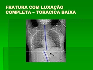 FRATURA COM LUXAÇÃO
COMPLETA – TORÁCICA BAIXA
 