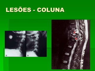 LESÕES - COLUNA
 