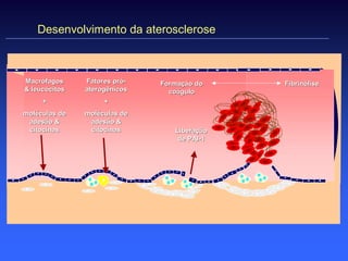 Desenvolvimento da aterosclerose



Macrófagos     Fatores pró-
                       pró-   Formação do    Fibrinólise
& leucócitos   aterogênicos     coágulo
     +              +
moléculas de   moléculas de
 adesão &       adesão &
 citocinas      citocinas        Liberação
                                  de PAI-1
                                     PAI-
 