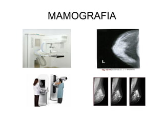 MAMOGRAFIA
 
