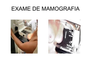 EXAME DE MAMOGRAFIA
 
