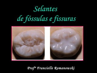 Selantes
de fóssulas e fissuras
Profª Francielle Romanowski
 