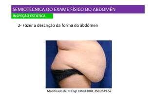 SEMIOTÉCNICA DO EXAME FÍSICO DO ABDOMÊN
INSPEÇÃO ESTÁTICA

  2- Fazer a descrição da forma do abdômen




                    Modificado de: N Engl J Med 2004;350:2549-57.
 