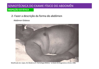 SEMIOTÉCNICA DO EXAME FÍSICO DO ABDOMÊN
INSPEÇÃO ESTÁTICA

  2- Fazer a descrição da forma do abdômen
     Abdômen Globoso




  Modificado de: López, M; Medeiros JL. Semiologia Médica - as bases do diagnóstico clínico; 1986.
 