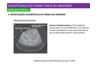 SEMIOTÉCNICA DO EXAME FÍSICO DO ABDOMÊN
INSPEÇÃO ESTÁTICA
2- MODIFICAÇÕES ASSIMÉTRICAS DA FORMA DO ABDÔMEN

    Abaulamentos localizados:

                                           Exames Complementares: TC de abdômen
                                           revelou AAA , 15 cm de diâmetro, com extenso
                                           trombo intraluminal; o aneurisma extendia-se
                                           até sua bifurcação próximo à ilíaca direita;




                          Modificado de N Engl J Med 362; january 7, 2010
 