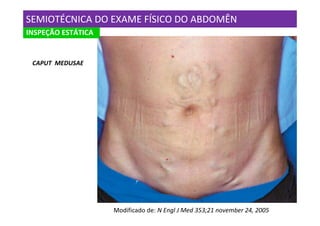 SEMIOTÉCNICA DO EXAME FÍSICO DO ABDOMÊN
INSPEÇÃO ESTÁTICA


 CAPUT MEDUSAE




                    Modificado de: N Engl J Med 353;21 november 24, 2005
 