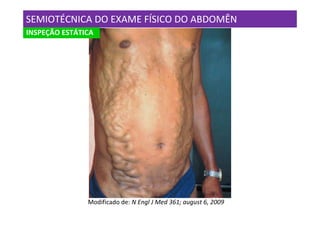 SEMIOTÉCNICA DO EXAME FÍSICO DO ABDOMÊN
INSPEÇÃO ESTÁTICA




               Modificado de: N Engl J Med 361; august 6, 2009
 