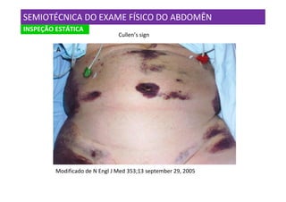 SEMIOTÉCNICA DO EXAME FÍSICO DO ABDOMÊN
INSPEÇÃO ESTÁTICA
                                Cullen’s sign




         Modificado de N Engl J Med 353;13 september 29, 2005
 