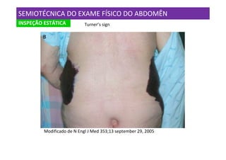 SEMIOTÉCNICA DO EXAME FÍSICO DO ABDOMÊN
INSPEÇÃO ESTÁTICA           Turner’s sign




         Modificado de N Engl J Med 353;13 september 29, 2005
 