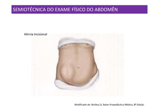 SEMIOTÉCNICA DO EXAME FÍSICO DO ABDOMÊN



    Hérnia Incisional




                        Modificado de: Bickley LS, Bates Propedêutica Médica, 8º Edição
 