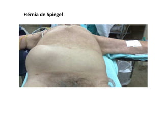 Hérnia de Spiegel
 