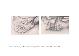 Modificado de: López, M; Medeiros JL. Semiologia Médica - as bases do diagnóstico clínico; 1986.
 
