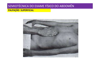 SEMIOTÉCNICA DO EXAME FÍSICO DO ABDOMÊN
PALPAÇÃO SUPERFICIAL
 