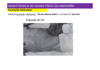 SEMIOTÉCNICA DO EXAME FÍSICO DO ABDOMÊN
PALPAÇÃO PROFUNDA
Palpação profunda e deslizante: “ fila dos últimos dedos” e manobra de “dar pele”

                    Palpação de FIE
 