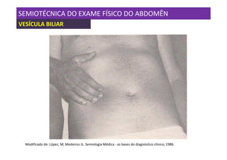 SEMIOTÉCNICA DO EXAME FÍSICO DO ABDOMÊN
VESÍCULA BILIAR




  Modificado de: López, M; Medeiros JL. Semiologia Médica - as bases do diagnóstico clínico; 1986.
 