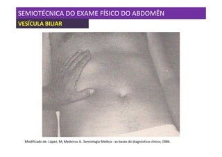 SEMIOTÉCNICA DO EXAME FÍSICO DO ABDOMÊN
VESÍCULA BILIAR




  Modificado de: López, M; Medeiros JL. Semiologia Médica - as bases do diagnóstico clínico; 1986.
 