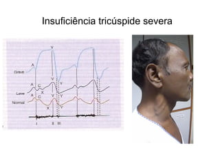 Insuficiência tricúspide severa
 