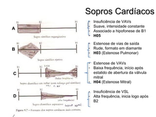 Sopros CardíacosSopros Cardíacos
- Insuficiência de VAVs
- Suave, intensidade constante
- Associado a hipofonese de B1
- H05
- Estenose de vias de saída
- Rude, formato em diamante
- H03 (Estenose Pulmonar)
- Estenose de VAVs
- Baixa frequência, início após
estalido de abertura da válvula
mitral
- H04 (Estenose Mitral)
- Insuficiência de VSL
- Alta frequência, inicia logo após
B2
A
B
C
D
 