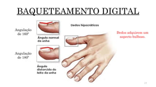 17
BAQUETEAMENTO DIGITAL
Dedos adquirem um
aspecto bulboso.
Angulação
de 160º
Angulação
de 180º
 