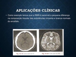 APLICAÇÕES CLÍNICAS
• Como exemplo temos que a RMN é sensível a pequena diferença
na composição tissular das substâncias cinzenta e branca normais
do encéfalo.
 