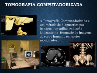 TOMOGRAFIA COMPUTADORIZADA
• A Tomografia Computadorizada é
um método de diagnóstico por
imagem que utiliza radiação
ionizante na formação de imagens
do corpo humano em cortes
seccionados .
 