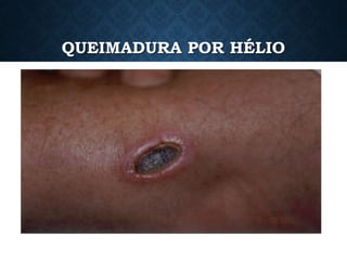 QUEIMADURA POR HÉLIO
 