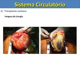 4) Transplante cardíaco
Imagens da cirurgia
Sistema CirculatórioSistema Circulatório
 