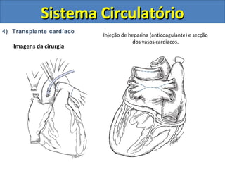 4) Transplante cardíaco
Imagens da cirurgia
Sistema CirculatórioSistema Circulatório
Injeção de heparina (anticoagulante) e secção
dos vasos cardíacos.
 
