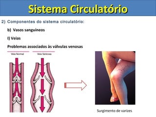 2) Componentes do sistema circulatório:
b) Vasos sanguíneos
I) Veias
Problemas associados às válvulas venosas
Sistema CirculatórioSistema Circulatório
Surgimento de varizes
 