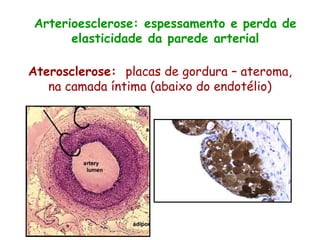 Aterosclerose: placas de gordura – ateroma,
na camada íntima (abaixo do endotélio)
Arterioesclerose: espessamento e perda de
elasticidade da parede arterial
 