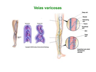 Veias varicosas
 