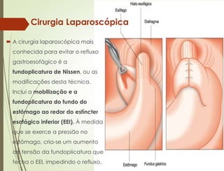  A cirurgia laparoscópica mais
conhecida para evitar o refluxo
gastroesofágico é a
fundoplicatura de Nissen, ou as
modificações desta técnica.
Inclui a mobilização e a
fundoplicatura do fundo do
estômago ao redor do esfíncter
esofágico inferior (EEI). À medida
que se exerce a pressão no
estômago, cria-se um aumento
de tensão da fundoplicatura que
fecha o EEI, impedindo o refluxo.
Cirurgia Laparoscópica
 