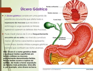 Úlcera Gástrica
 A úlcera gástrica consiste em uma perda de
substância circunscrita que afeta toda a
espessura da mucosa que recobre o
estômago e surge quando os fatores
agressivos superam as defesas das mucosas.
 Pode medir menos de 2 cm e frequentemente
encontra-se no antro, no nível da curvatura
menor. De forma característica apresenta
fundo limpo, bordas nítidas e pregas gástricas
normais que confluem ao nicho ulceroso.
OBS: Úlcera é o nome genérico dado
a quaisquer lesões superficiais em
tecido cutâneo ou mucoso,
popularmente denominadas feridas.
Nessas lesões ocorre a ruptura do
epitélio, de modo a haver exposição
de tecidos mais profundos. Uma afta
é, por exemplo, uma úlcera na boca.
 