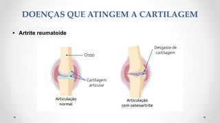 DOENÇAS QUE ATINGEM A CARTILAGEM
• Artrite reumatoide
 