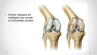 • Artrose: desgaste da
cartilagem que reveste
as articulações (juntas).
 